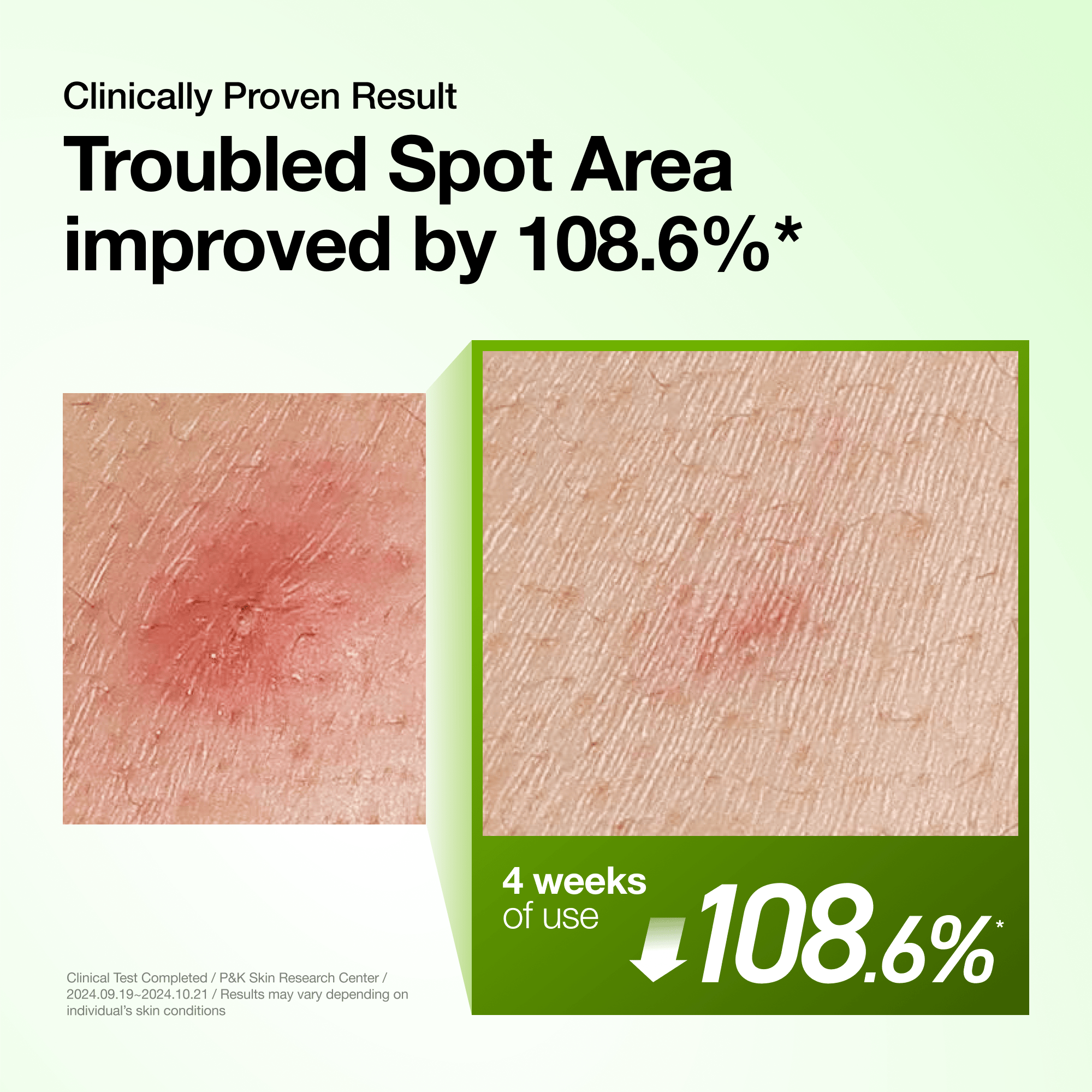 Anua Azelaic Acid 10 Hyaluron Redness Soothing Serum - view 4